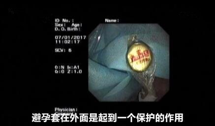 怀化一男子喝酒误吞瓶盖，医生巧用避孕套取出，我们该吸取哪些教训？