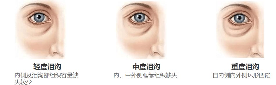 泪沟纹怎么形成的？