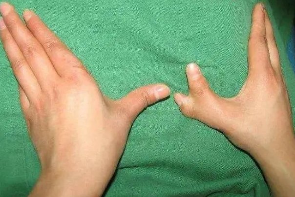 六指的人有什么说法