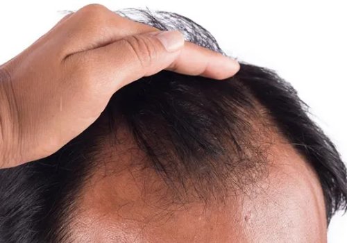 头发细软稀少怎么改善