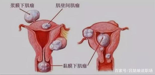 子宫肌瘤怎么治最好?