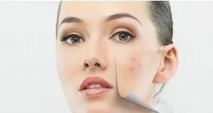 有效去痘痘产品：去痘印最有效的方法？怎么去痘印