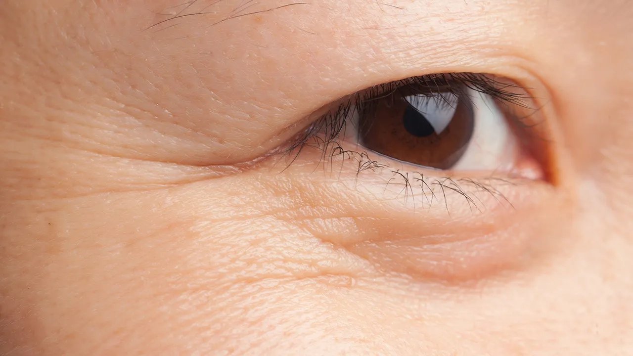 如何去除眼部鱼尾纹