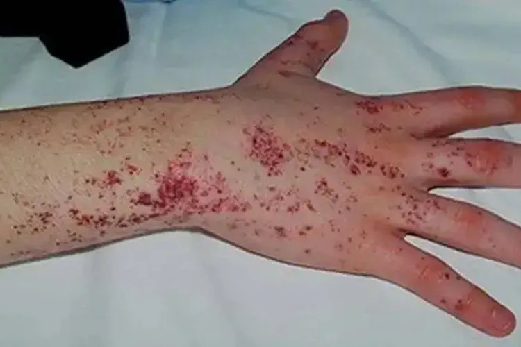 手上突然冒出紫色点点图片