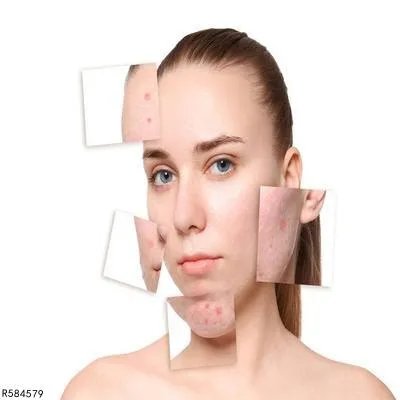 如何有效去黑头小方法