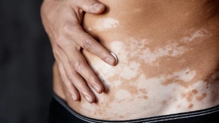 哈尔滨白癜风医院:白癜风手拉手传染不