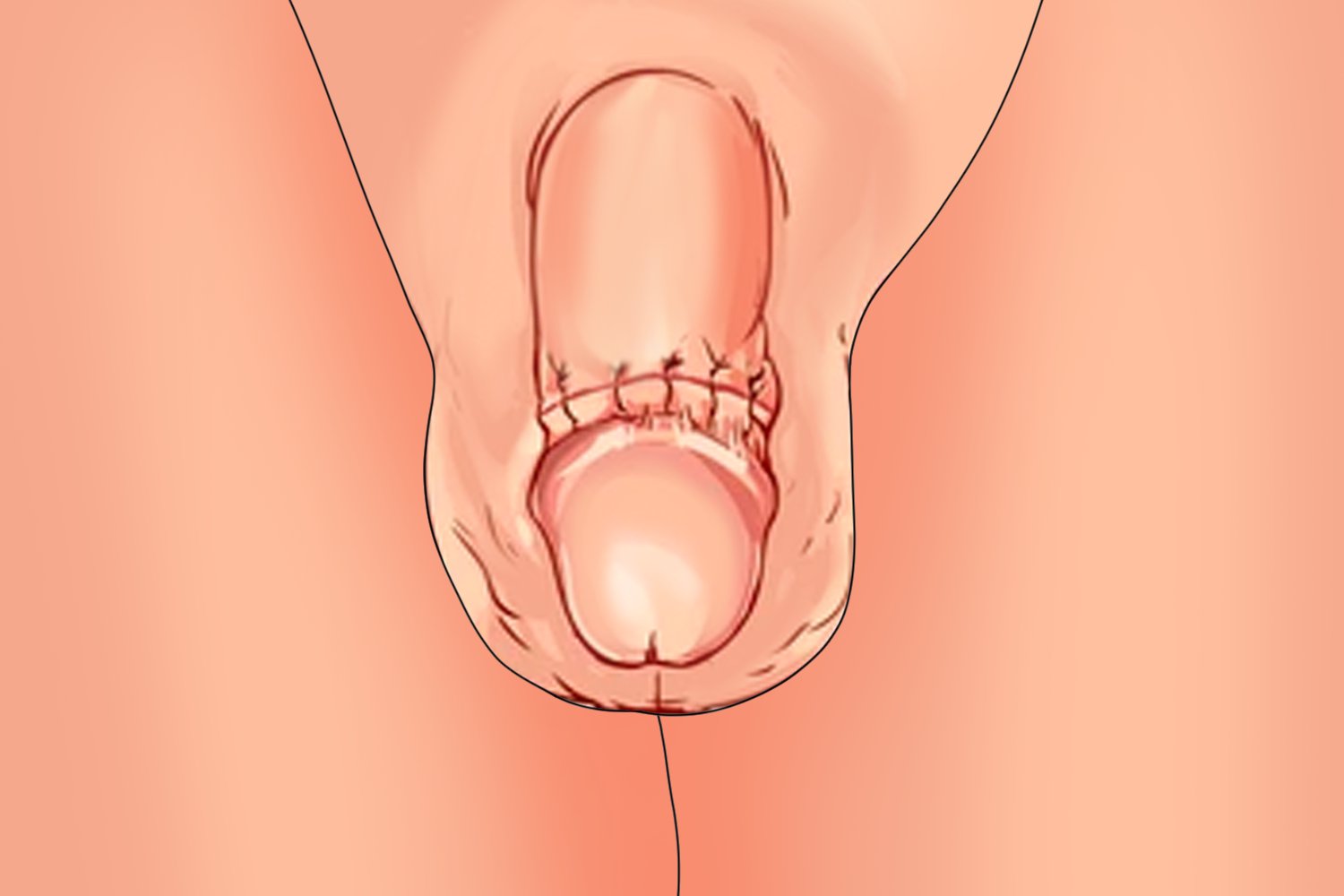 包皮过长术后图片