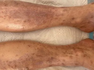 慢性湿疹小腿症状图片