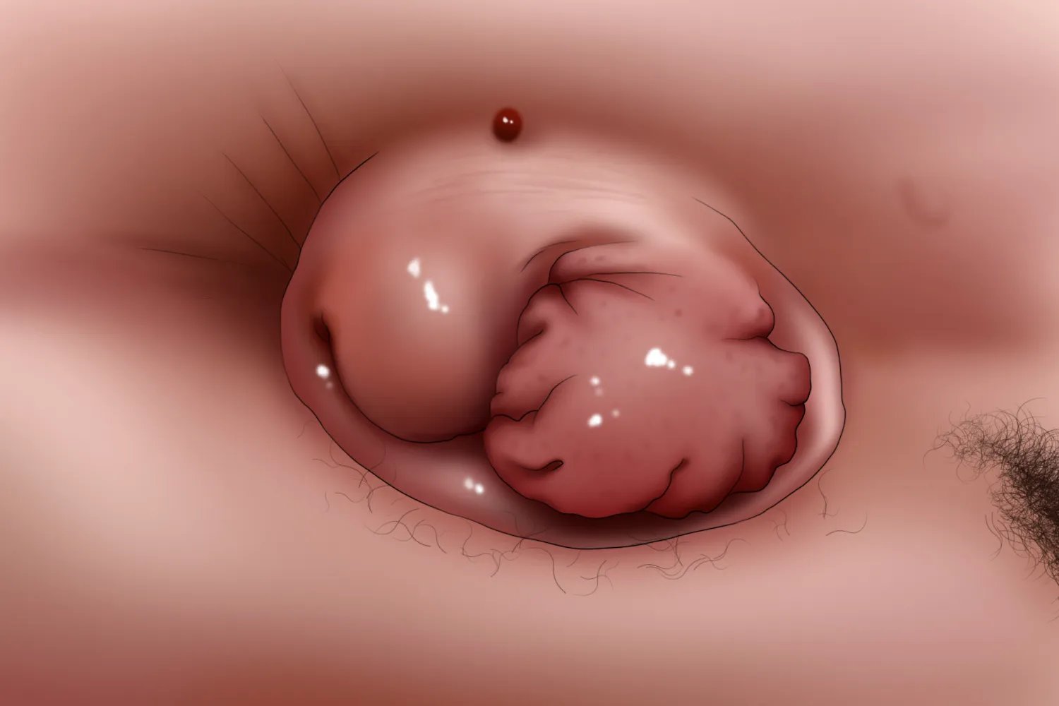 痔疮是什么形状的照片