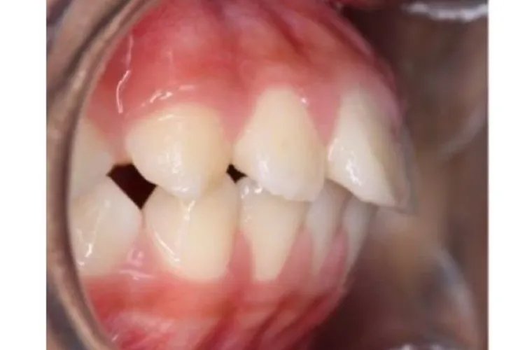 需要矫正的牙齿类型图片