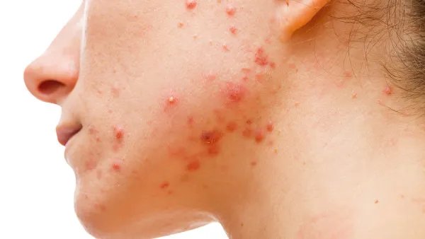 激光祛痘怎么样