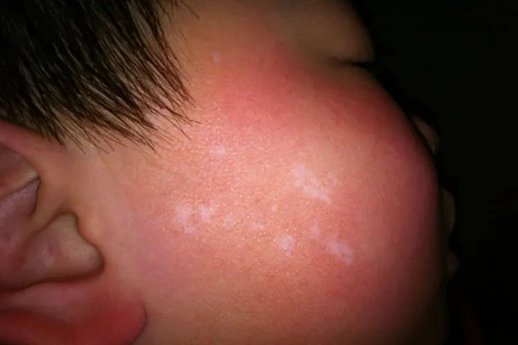 白斑初期症状图片是什么样