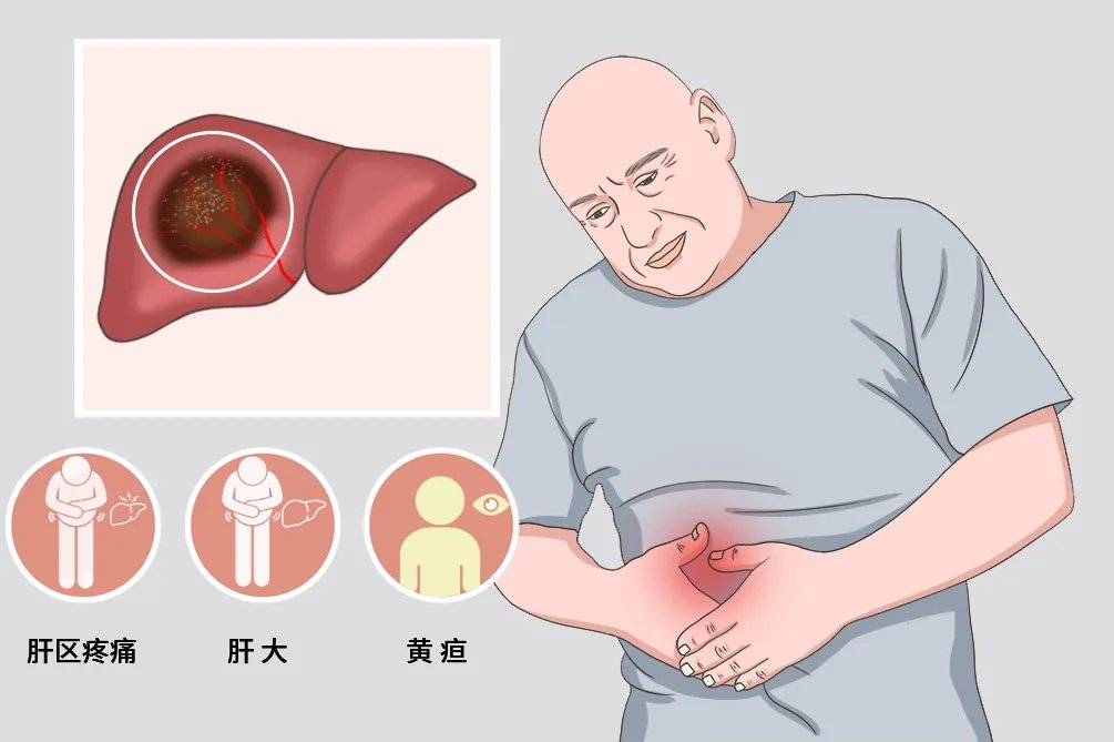 肝癌的早期症状和图片