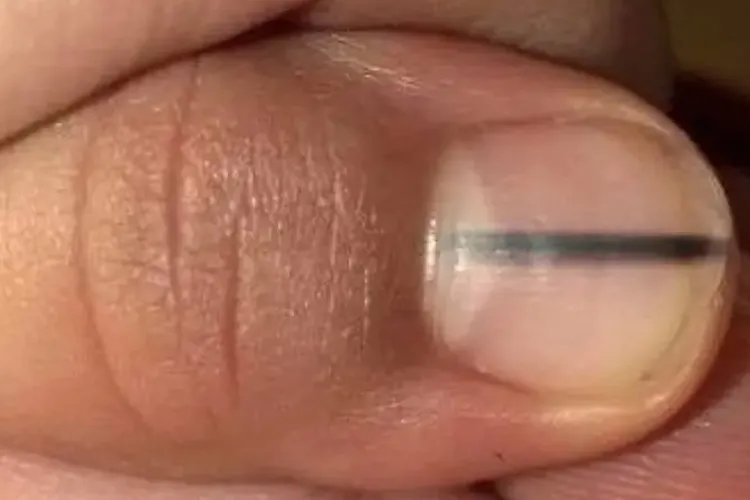 甲黑色素瘤图片