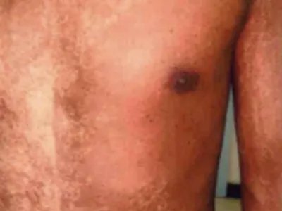 家族性进行性色素沉着症胸部斑图片