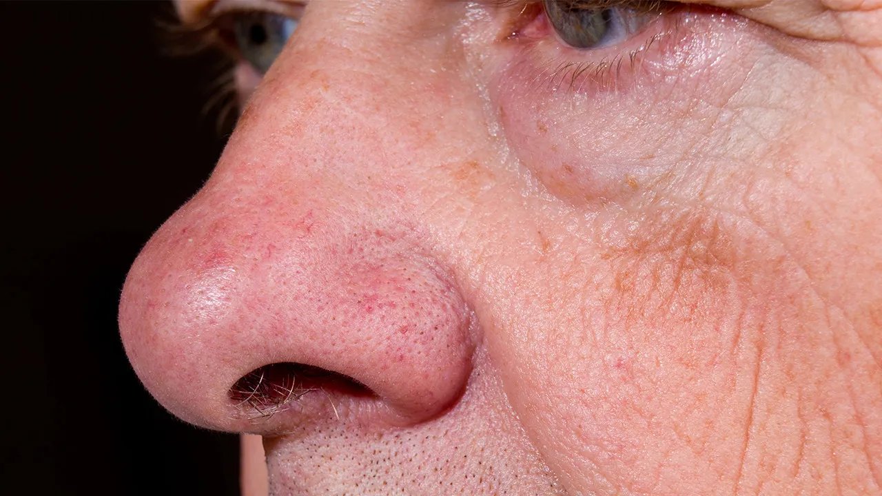 手术去眼袋多少钱