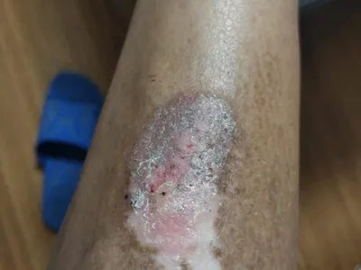 慢性湿疹小腿症状图片