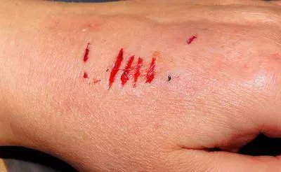 人工性荨麻疹有哪些症状表现?