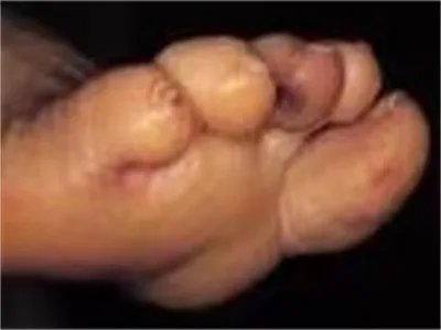 战壕热症状图片