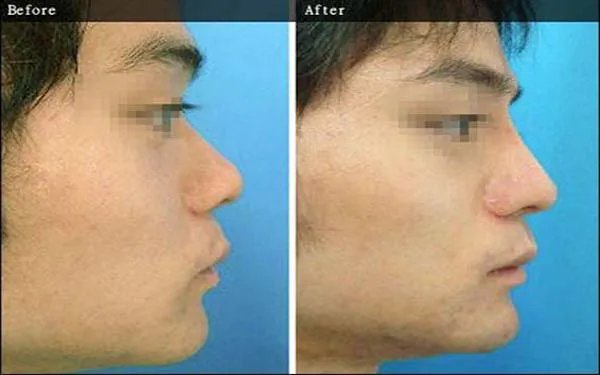 成都硅胶隆鼻医院哪里比较好