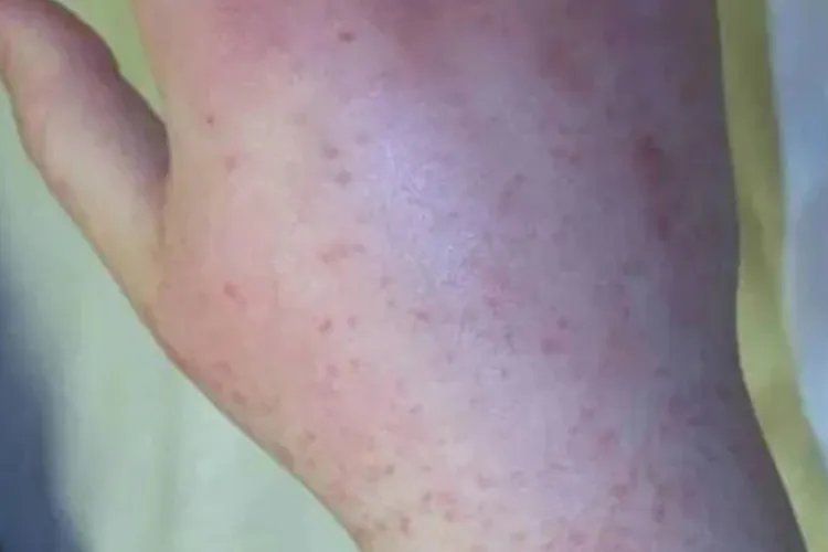 手上突然冒出紫色点点图片