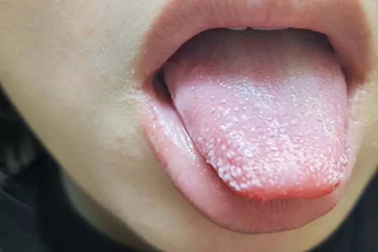 毛舌舌尖白点图片