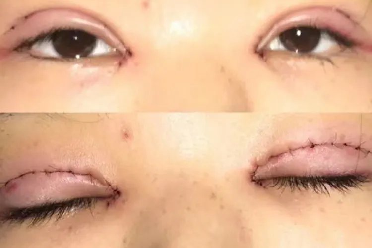 全切双眼皮第五天图片