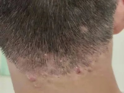 毛囊炎硬疙瘩图片