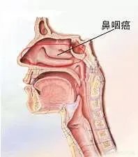 金宇彬得鼻咽癌,这个病能治愈吗?