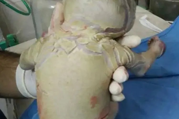 新生儿鱼鳞病初期症状图片