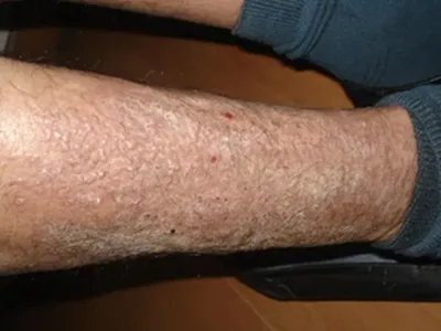 慢性湿疹小腿症状图片