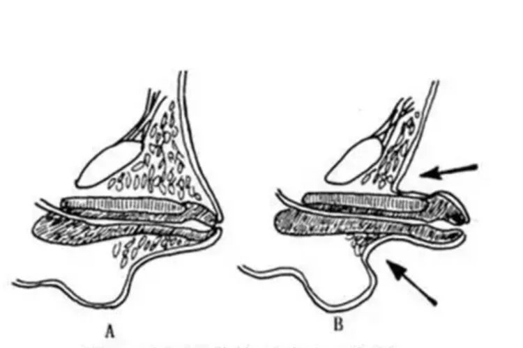 隐匿性阴茎图片