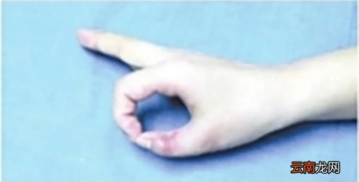 拉手幸福女孩，多指多福女孩切除多指牵住幸福