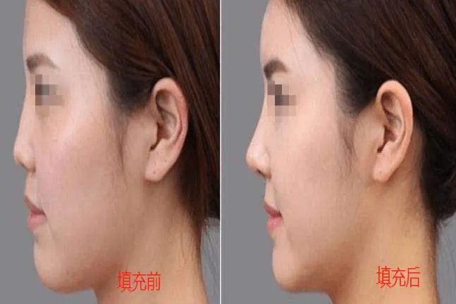 玻尿酸填充鼻子图片