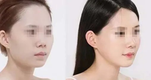 北京软骨隆鼻多少钱