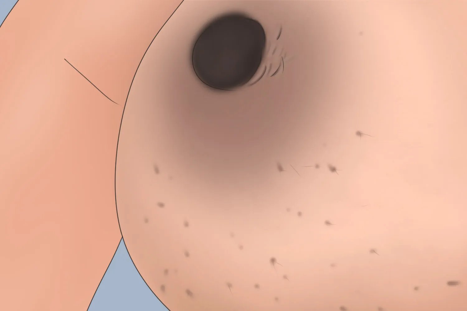 乳腺癌的前兆图片