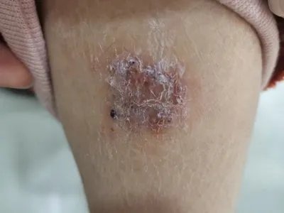 慢性湿疹小腿症状图片