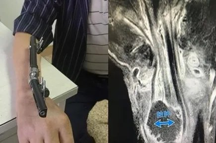 被虾刺中险被截肢：是怎么回事,小小海虾引起风波真相