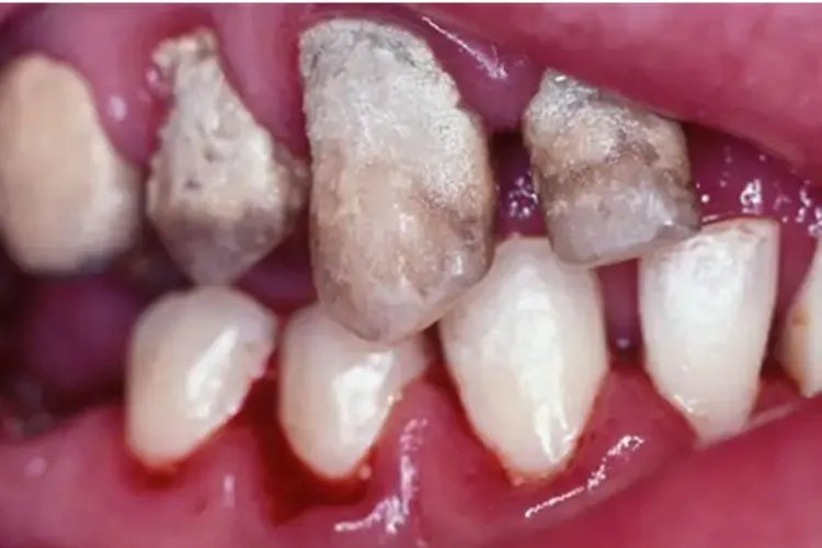 牙石是什么样的