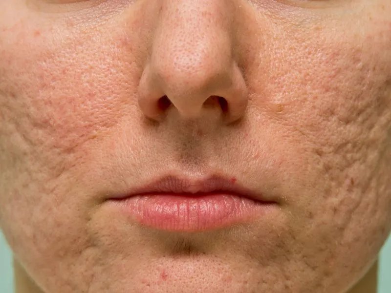 激光治痘疤有用吗