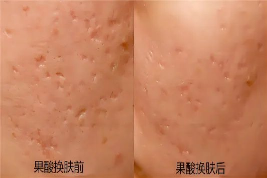 果酸换肤后脸效果图