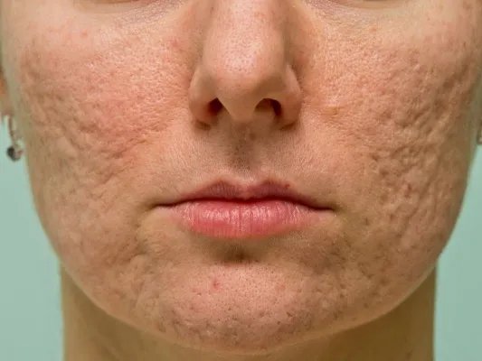 怎么去除青春痘疤痕