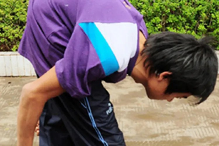 轻微驼背和严重驼背的图片