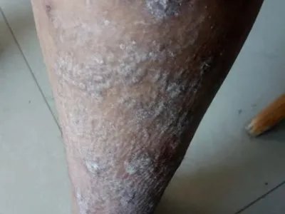 慢性湿疹小腿症状图片