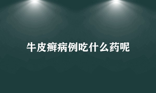 牛皮癣病例吃什么药呢