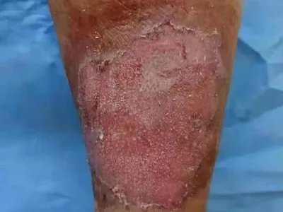 慢性湿疹小腿症状图片