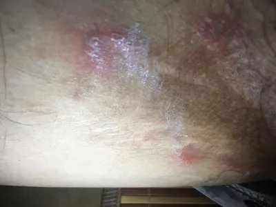 外阴蛲虫病症状图片