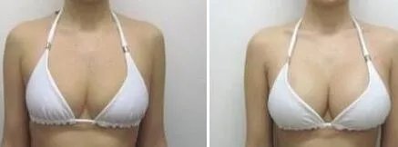 麦格隆胸假体手术价钱