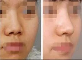 肥厚鼻尖矫正的技术方法