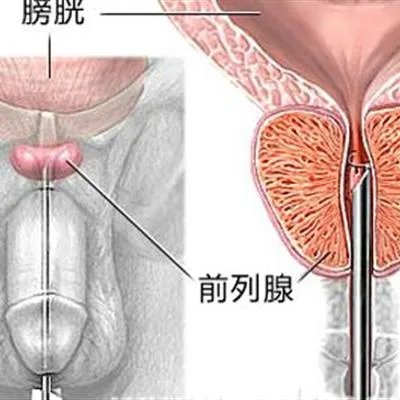 北京包茎什么原因?